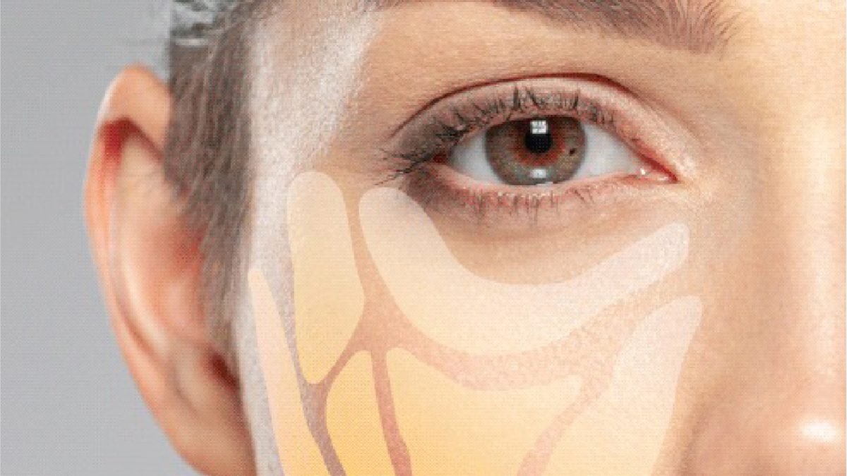 Adipoestructuracion facial no quirurgica