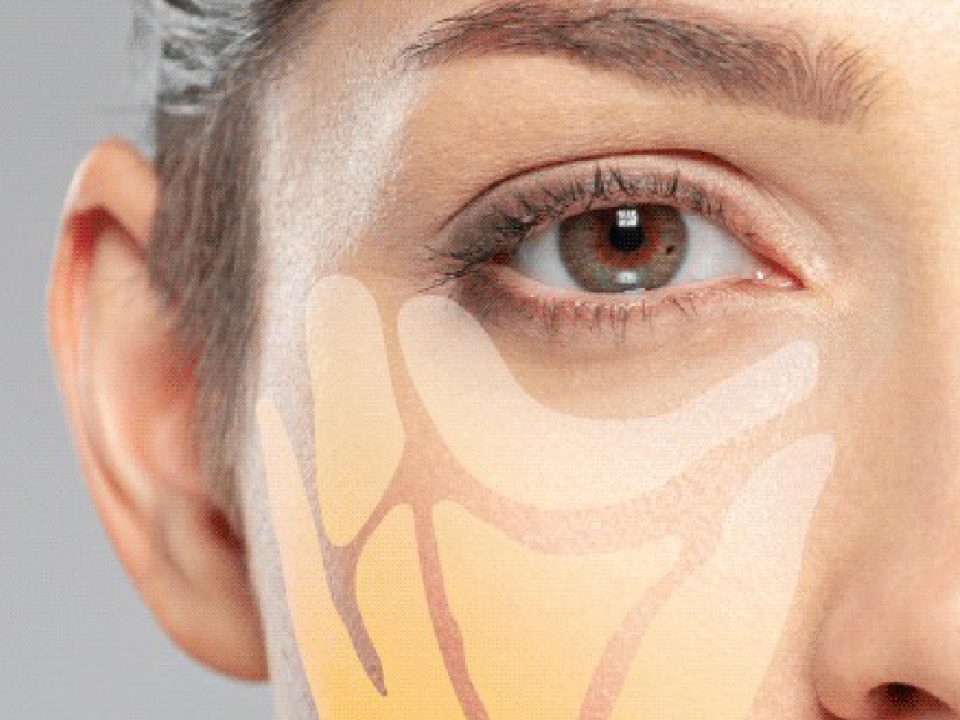 Adipoestructuracion facial no quirurgica